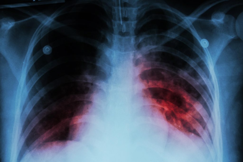 Día Mundial de la Tuberculosis, ¿cuál es el origen y la importancia de esta efeméride?